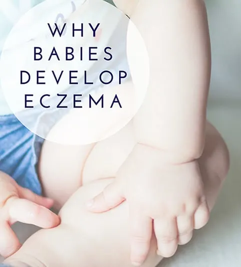 Why Babies Develop Eczema, Diet And Food Ideas To Heal Naturally